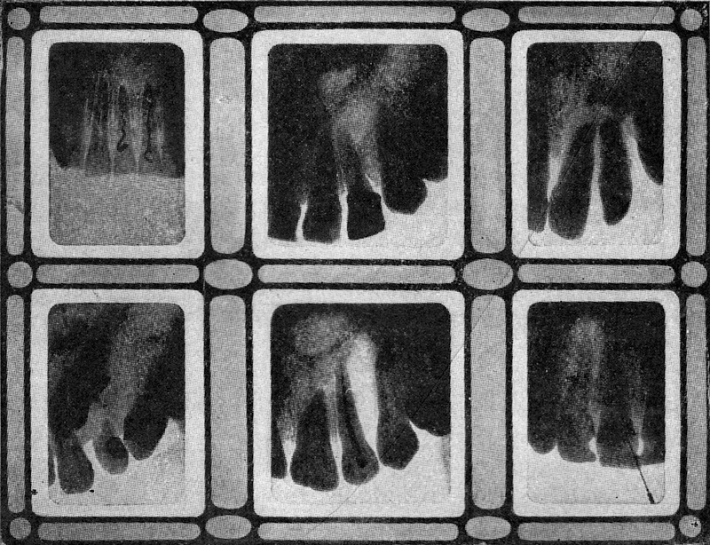X-ray pictures of teeth, taken in 1909 and published in the December 1909 issue of Popular Electricity magazine